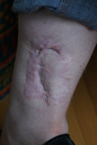my RIGHT ankle - 5 years after